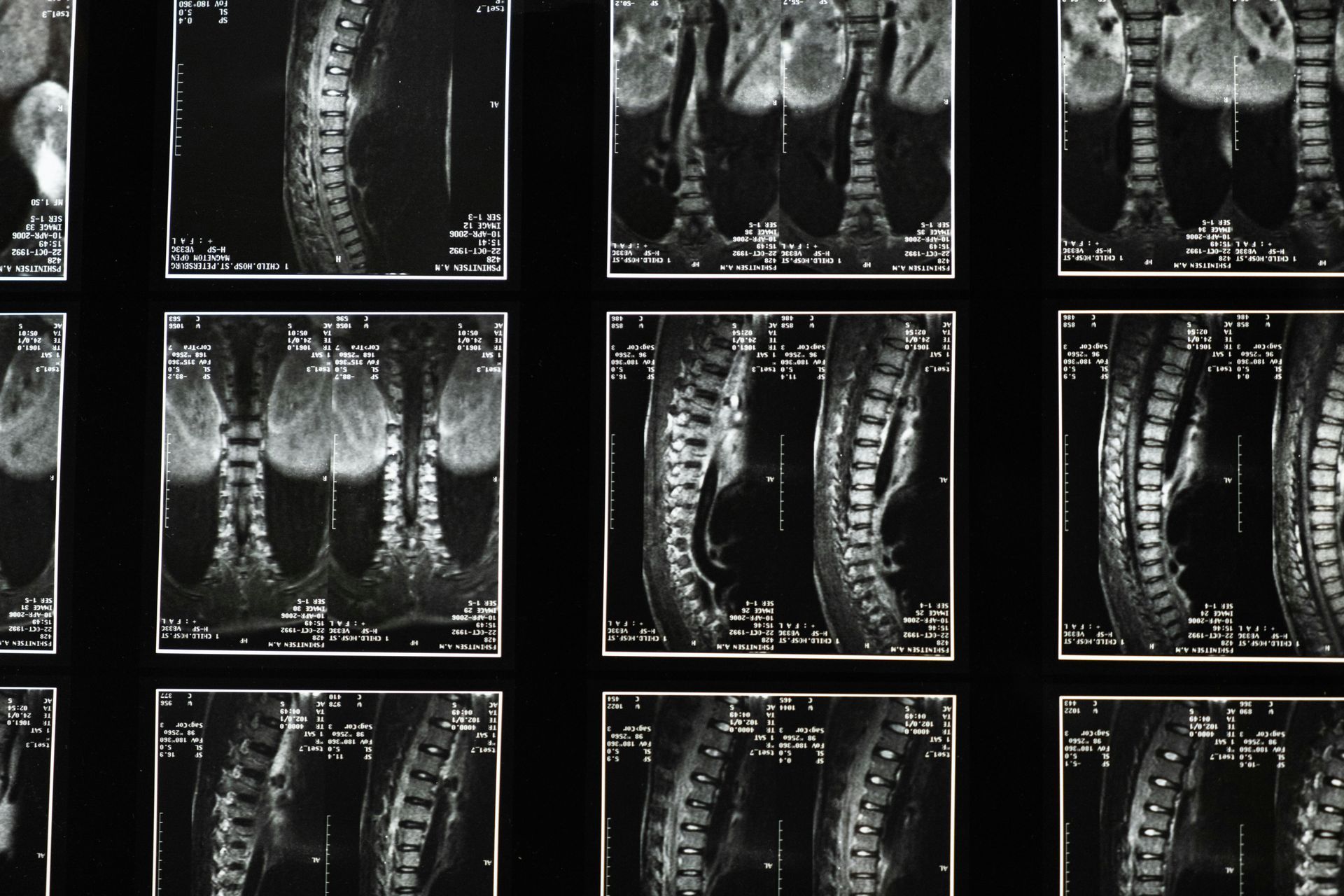 A grid of grayscale MRI scans of a human spine and surrounding soft tissue.