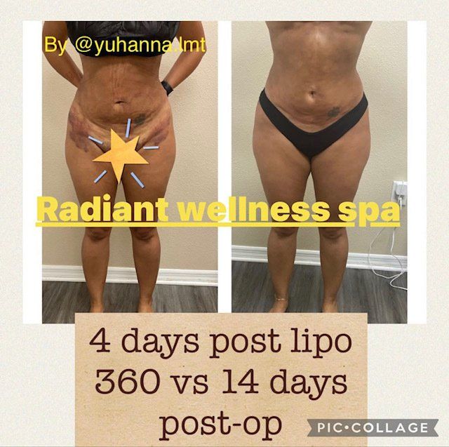Before and after images of post-operative care and body contouring