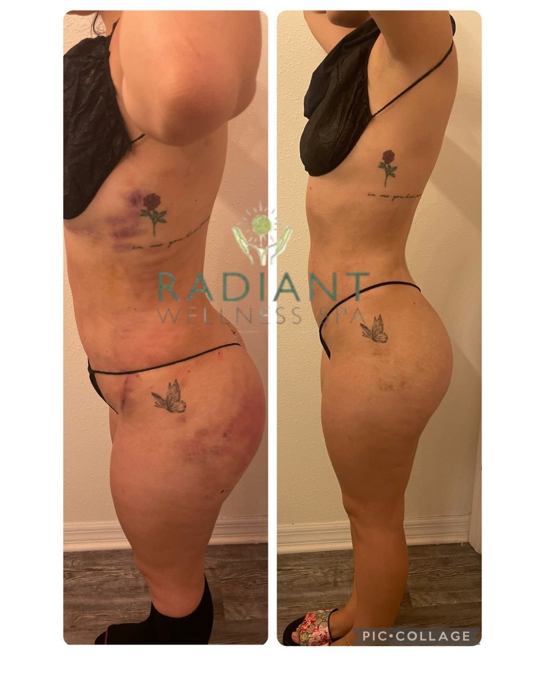 profile of body before and after post-op MLD