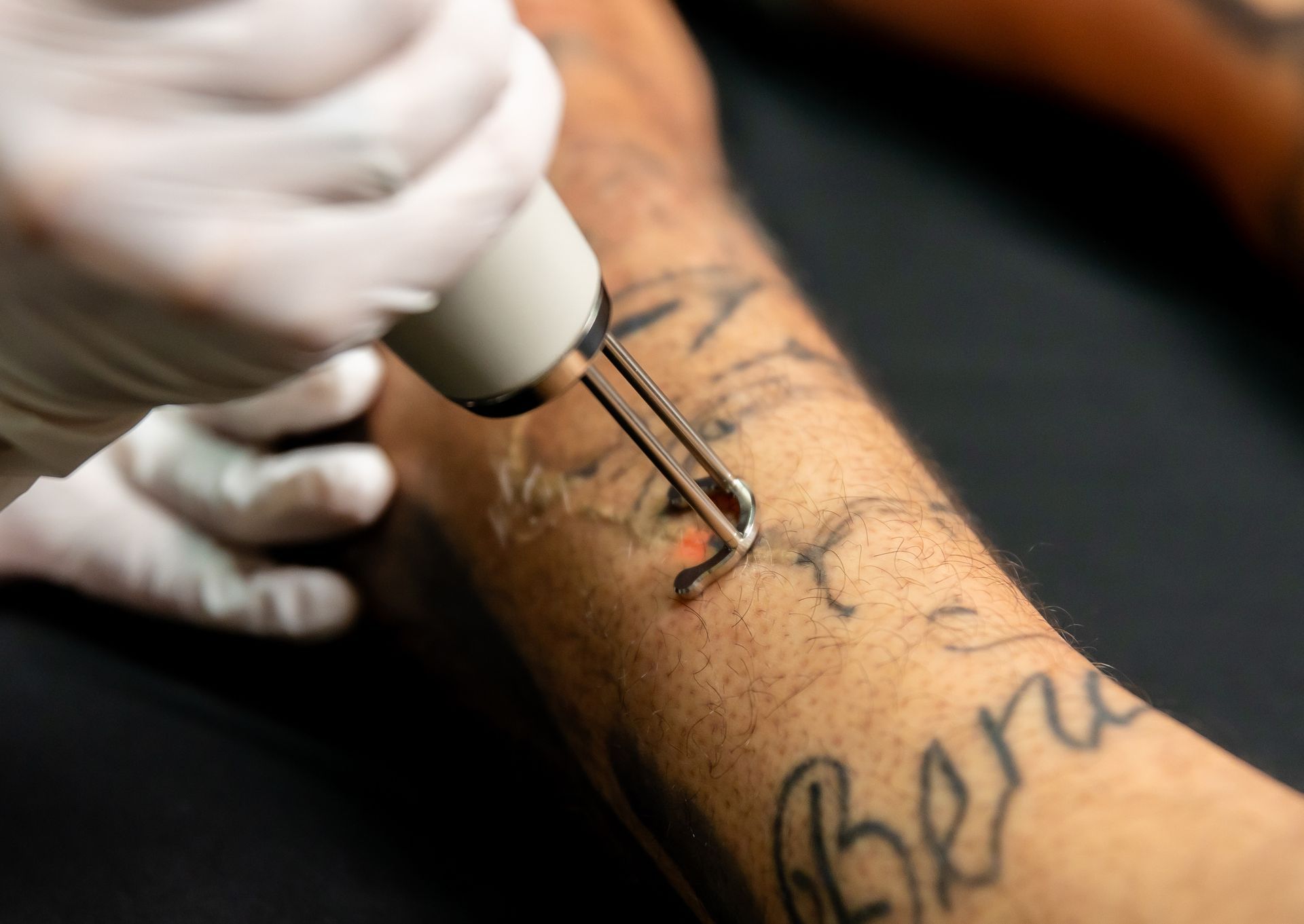 Laser tattoo removal on a person's arm by a gloved hand, with visible tattoo and removal tool.