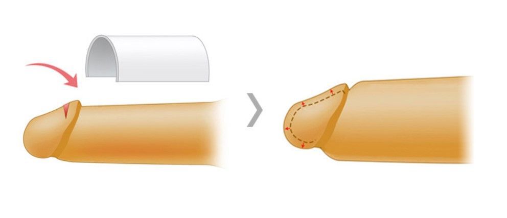 Acellular Dermal Matrix augmentation procedure — Urogyn Busan