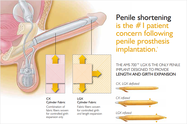 Diagram comparing AMS 700 CX and LGX penile implant cylinder expansion, highlighting length and girth benefits.