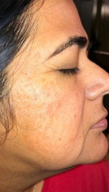 after microneedling service