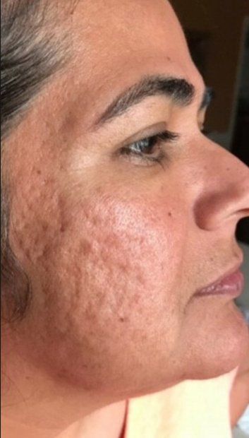 before microneedling service