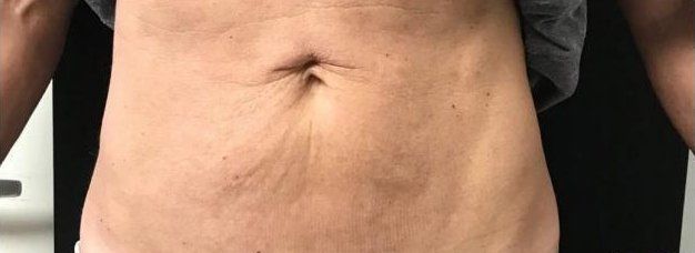 after stomach sculpting