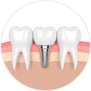 GREENMED IMPLANTOLOGIA (IMPLANTES)