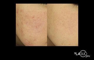 Side-by-side comparison of skin before and after acne treatment, showing reduction in blemishes and smoother texture.