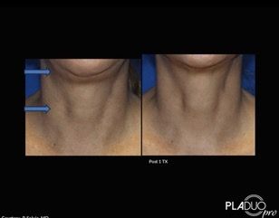 Side-by-side comparison of a neck before and after a treatment. The after shows smoother skin and reduced lines.