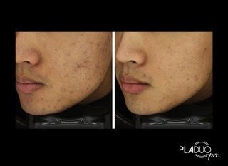 Side-by-side comparison of a person's face. Left side: acne and dark spots. Right side: clearer skin.