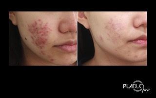 Before and after photos of a face, showing reduction of red skin condition on the cheek.