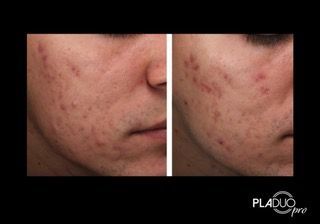 Acne treatment: side-by-side comparison of a person's face. Left side: before treatment. Right side: after treatment, reduced acne.