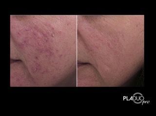 Comparison of a face with acne (left) and after treatment (right), showing reduced redness and smoother skin.