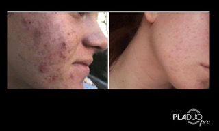 Before and after view of a face, showing acne reduction after Pladuo Pro treatment.