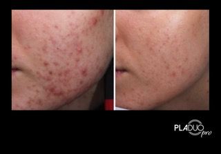 Before and after photo of facial skin, showing a reduction in acne and redness.