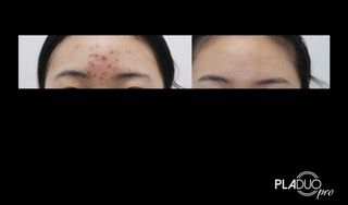 Before and after comparison of a person's forehead with acne, then clear skin.