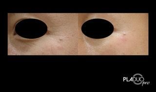 Before and after photos showing skin before and after treatment, focusing on the eye area.