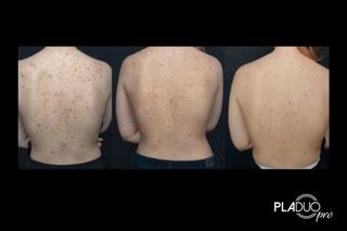 Back of torso before and after skin treatment, decreasing dark spots.