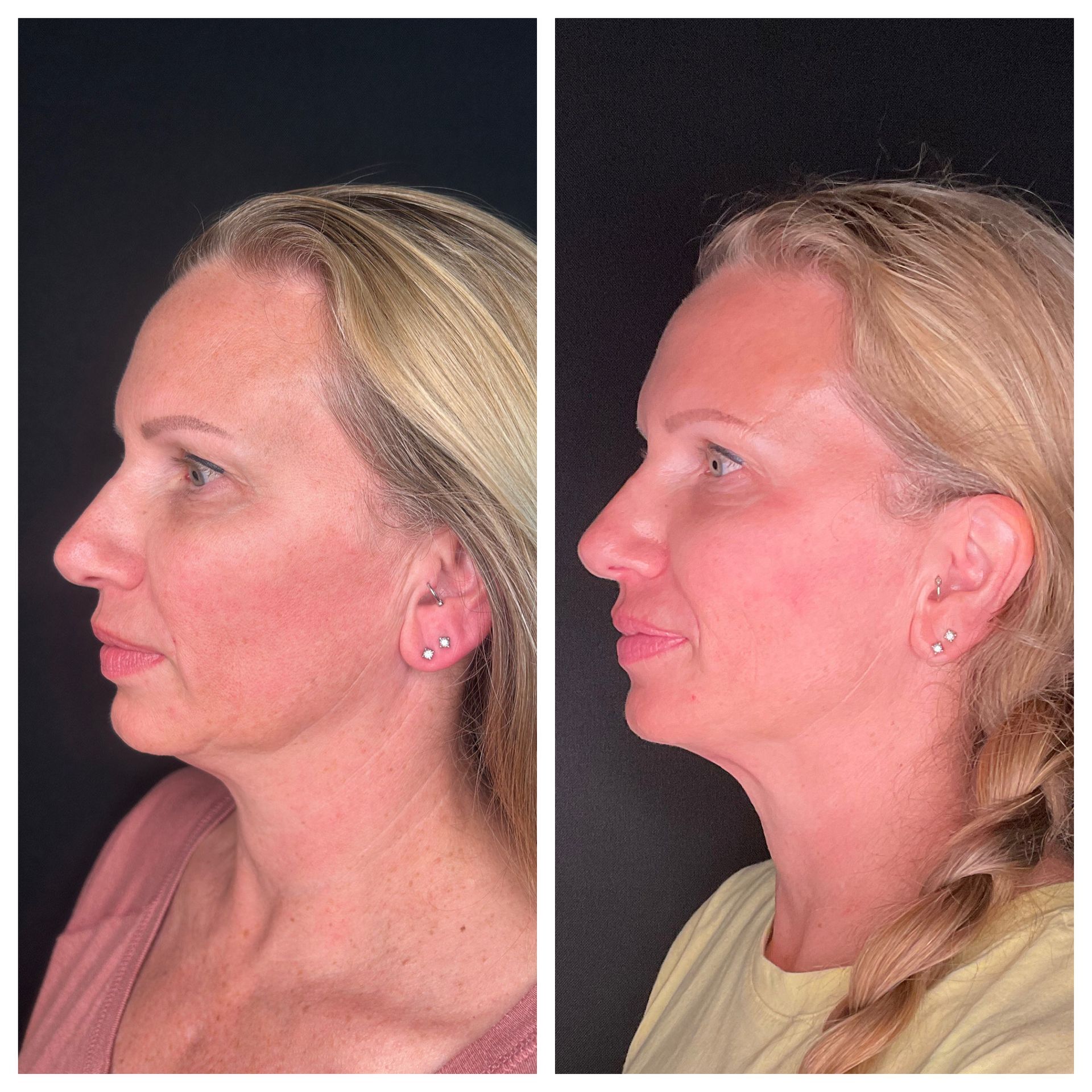 A before and after photo of a woman 's face.