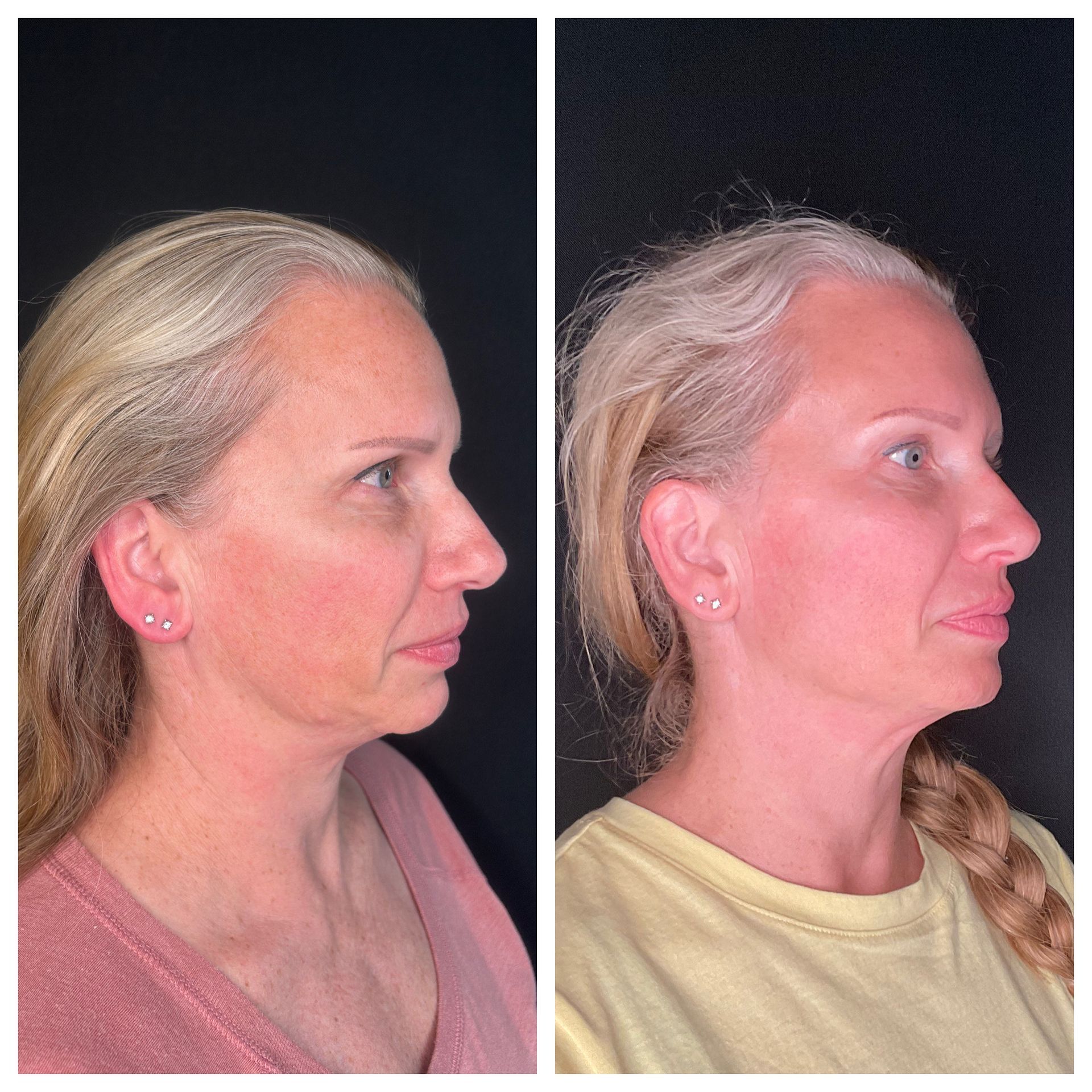A before and after photo of a woman 's face and neck.