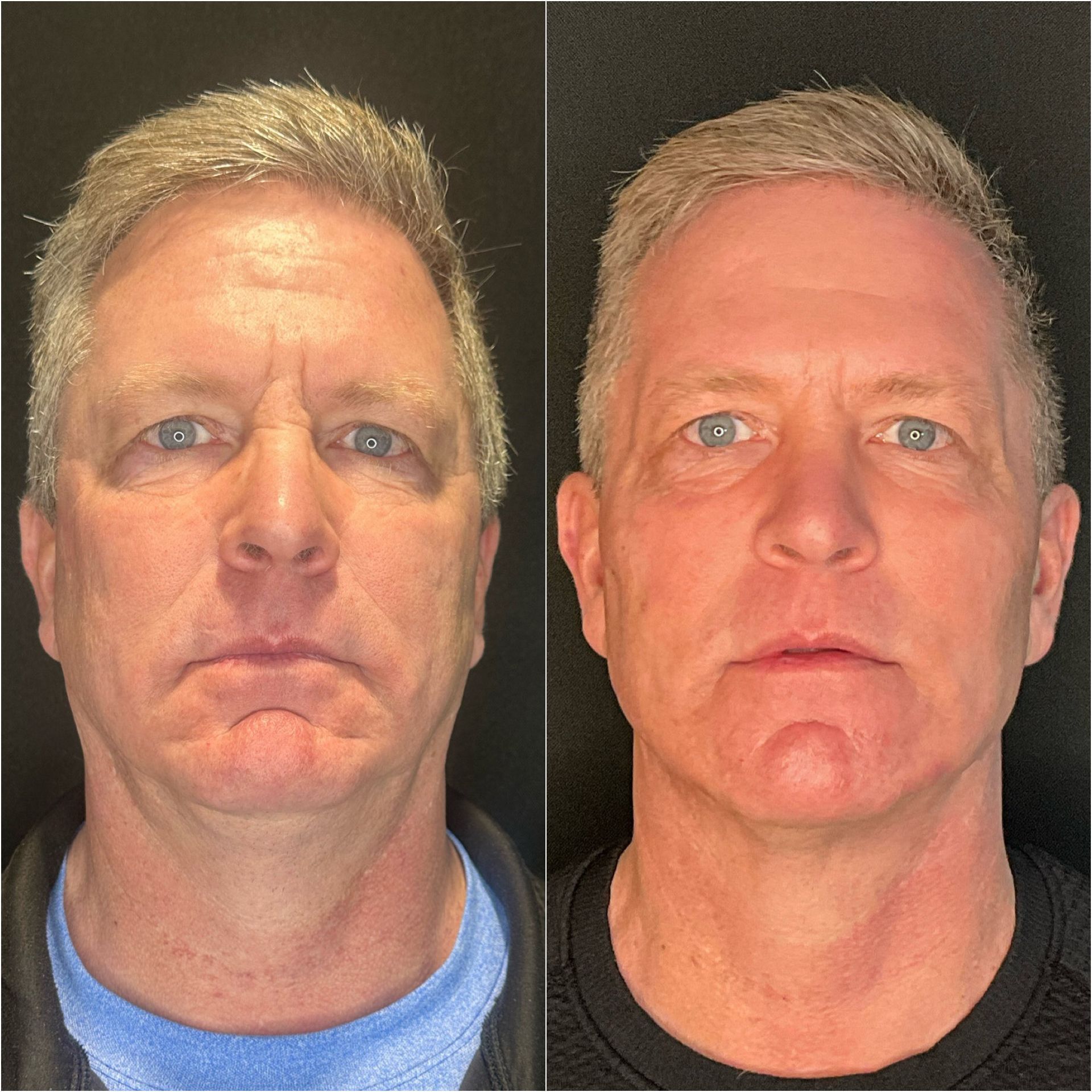 A before and after photo of a man 's face.