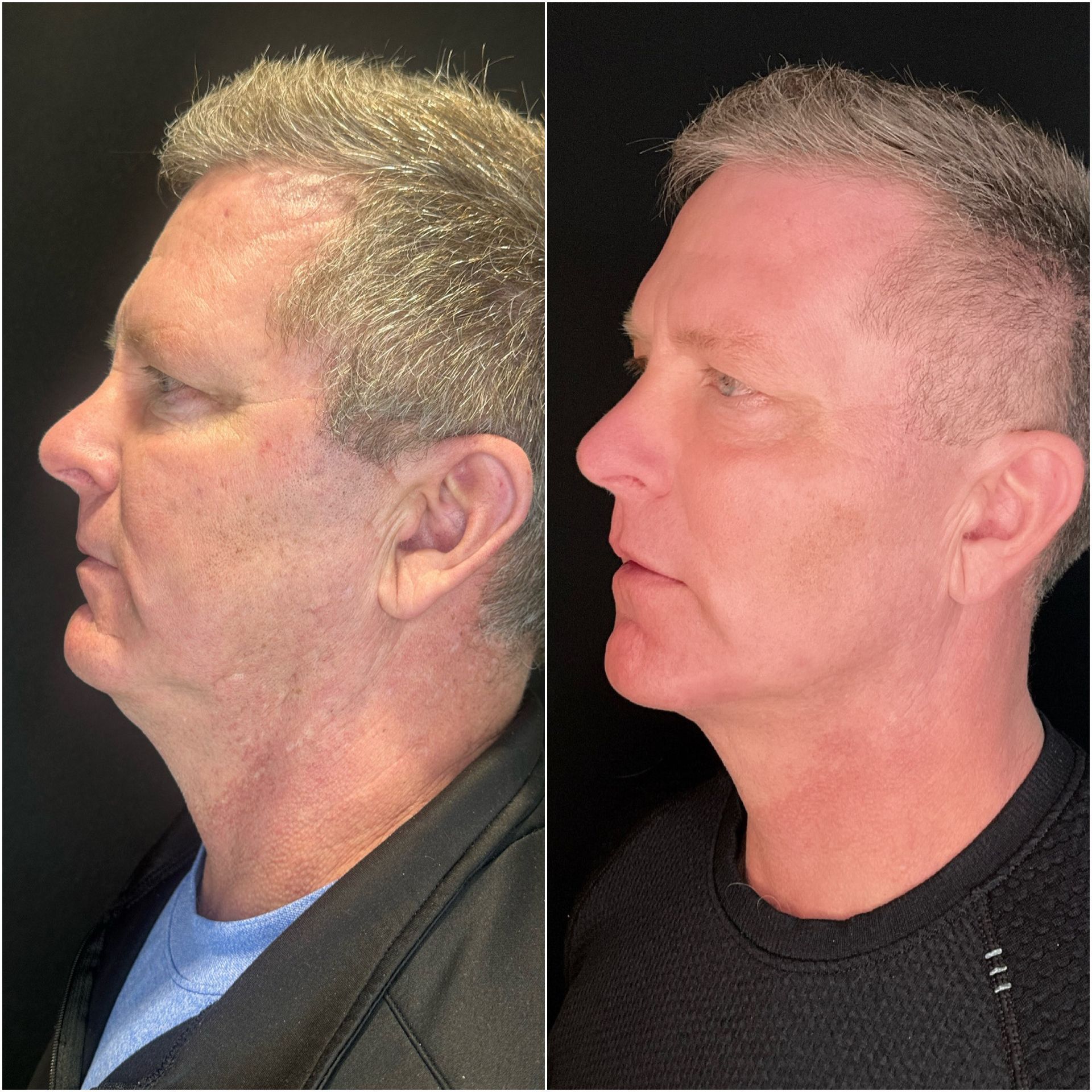 A before and after photo of a man 's face.