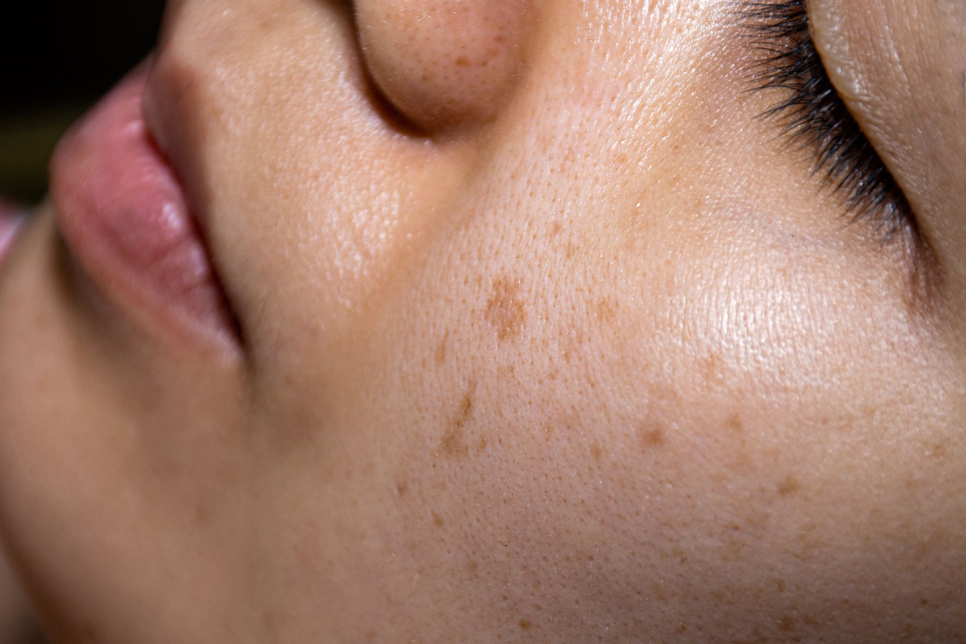 A close up of a woman 's face with brown spots on it.
