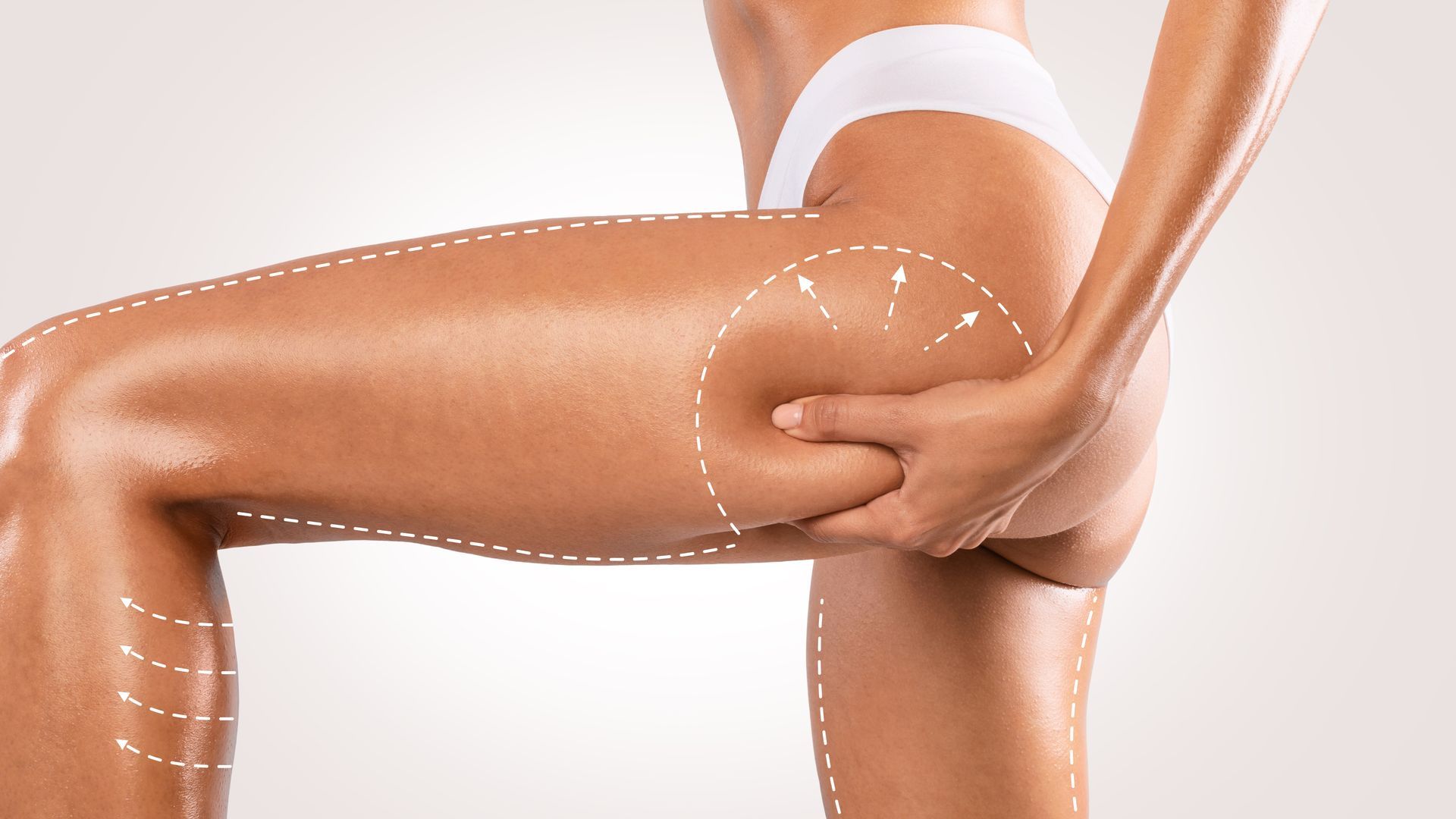 A woman is holding her thigh with lines drawn on it.