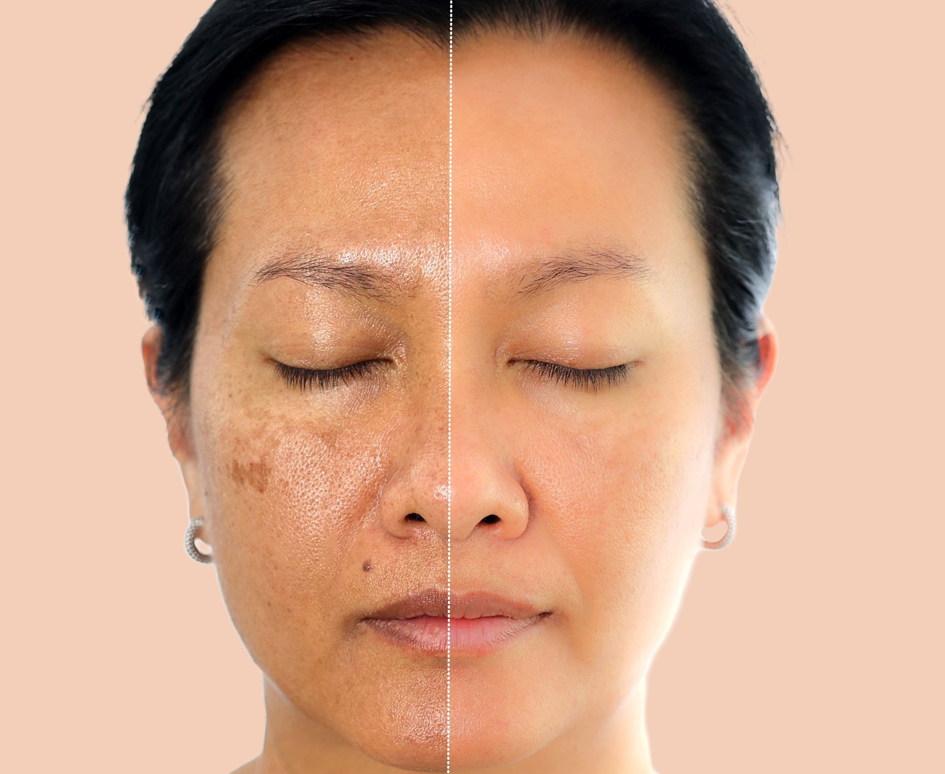 Face, halved to show skin with dark spots vs. even skin tone.