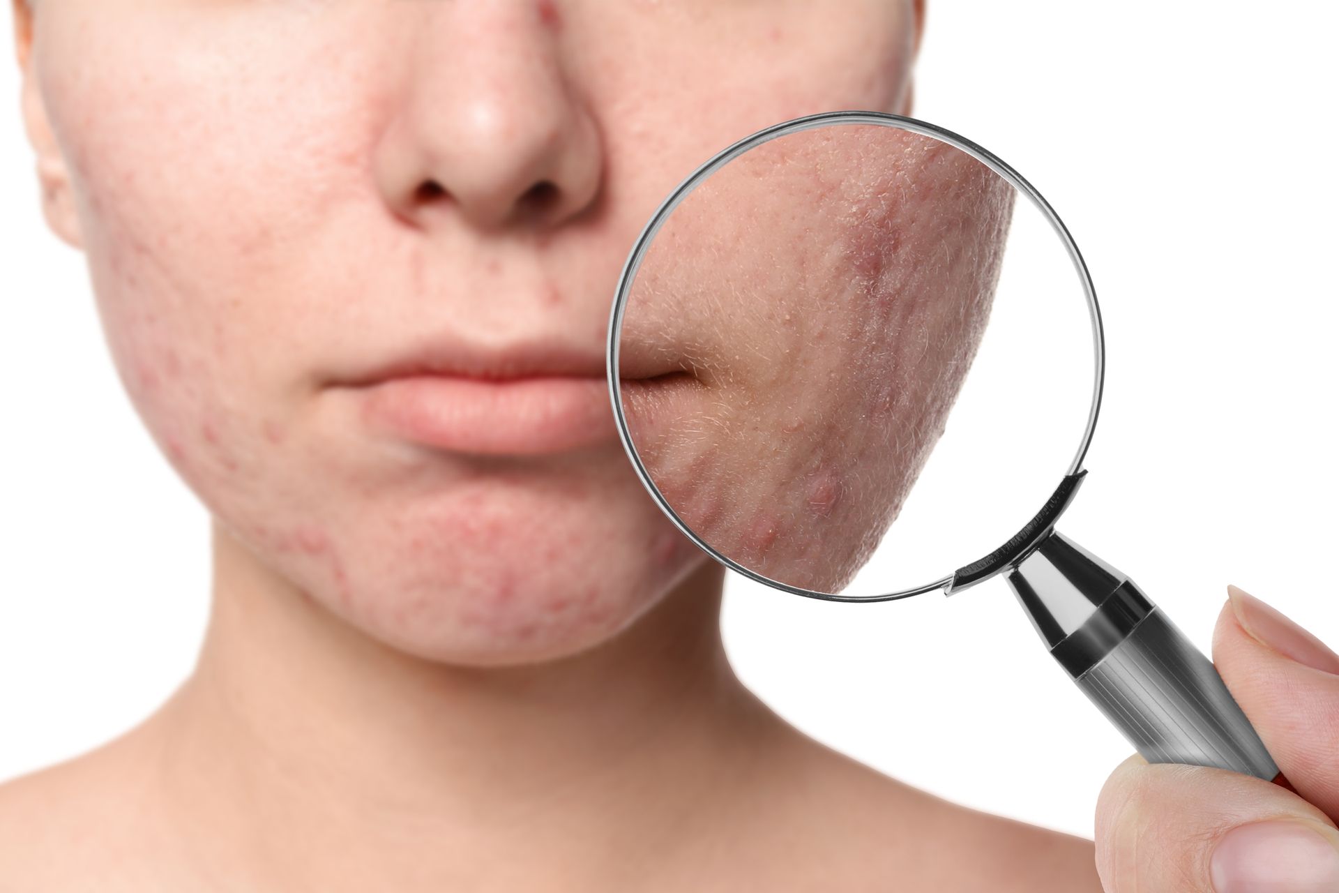 Person's face with acne magnified by a hand holding a magnifying glass.