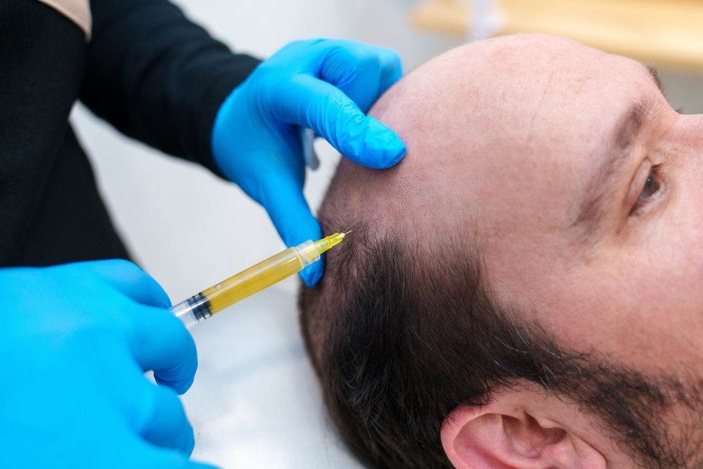 A person receiving an injection on their scalp. Someone in blue gloves holds a syringe near the bald area of the head.