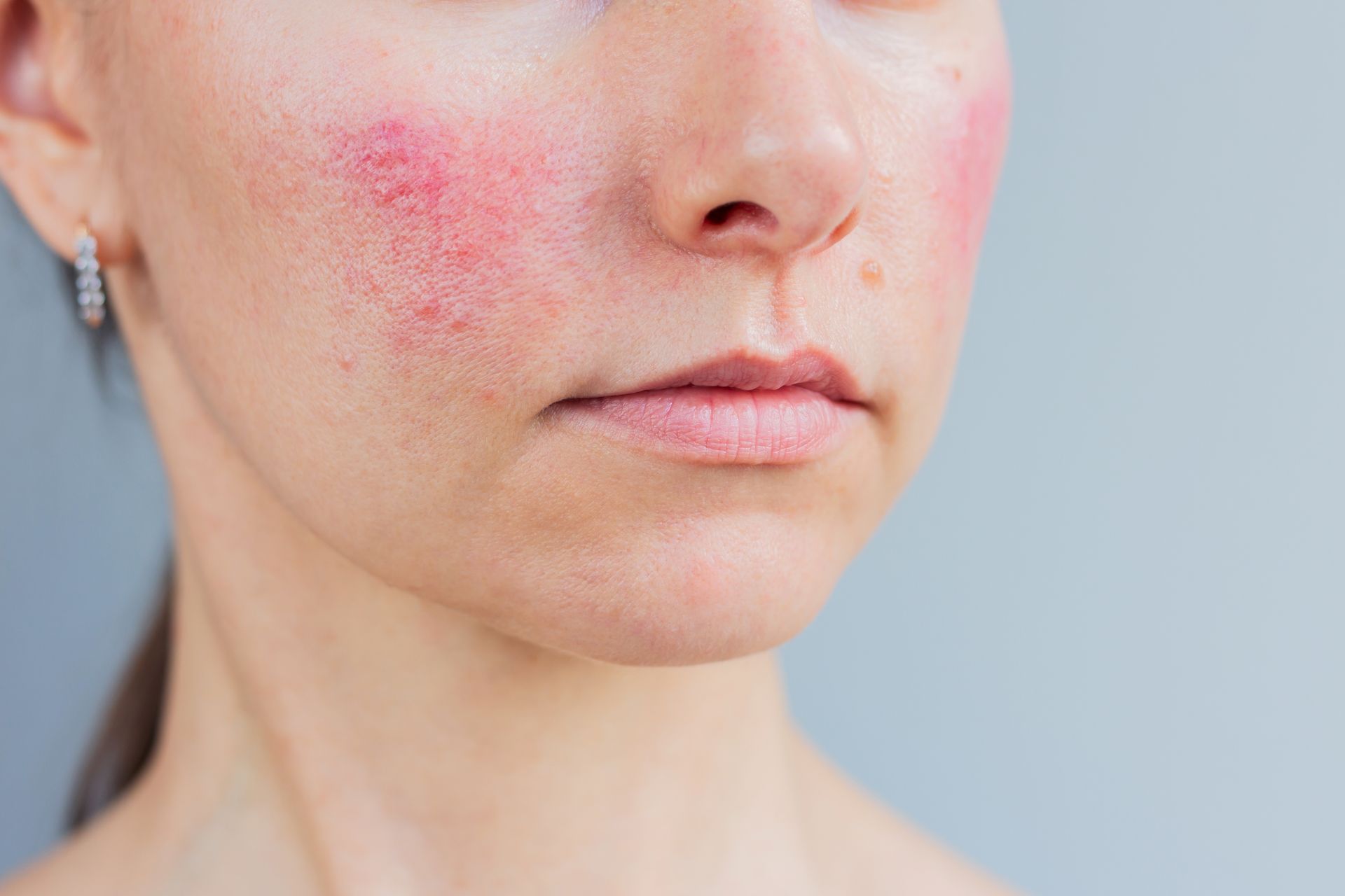 Woman's face with red, inflamed patches on cheeks, possibly indicating a skin condition. Neutral background.