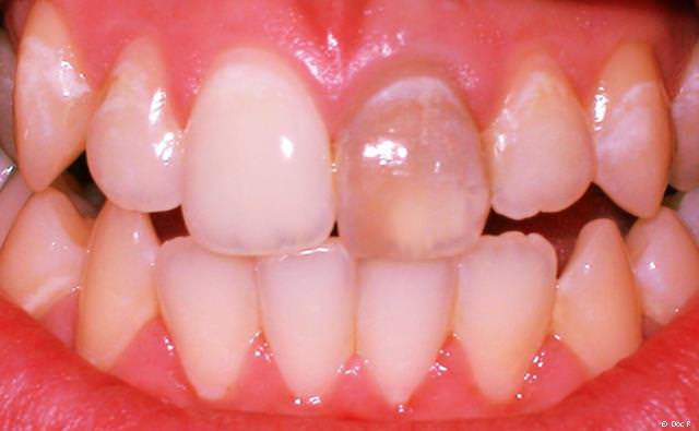 Auch einzelne dunkle Zähne können vom Zahnarzt wieder aufgehellt werden.