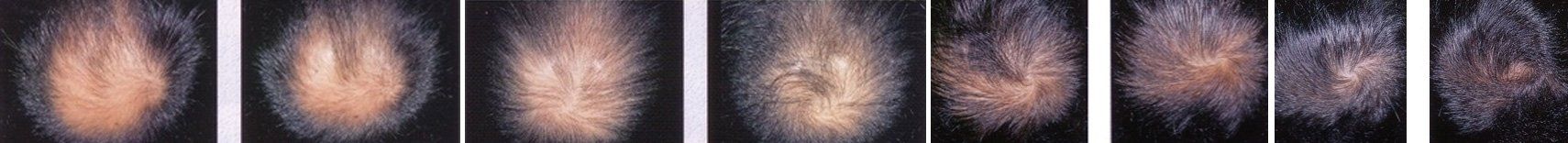 ricrescita dei capelli