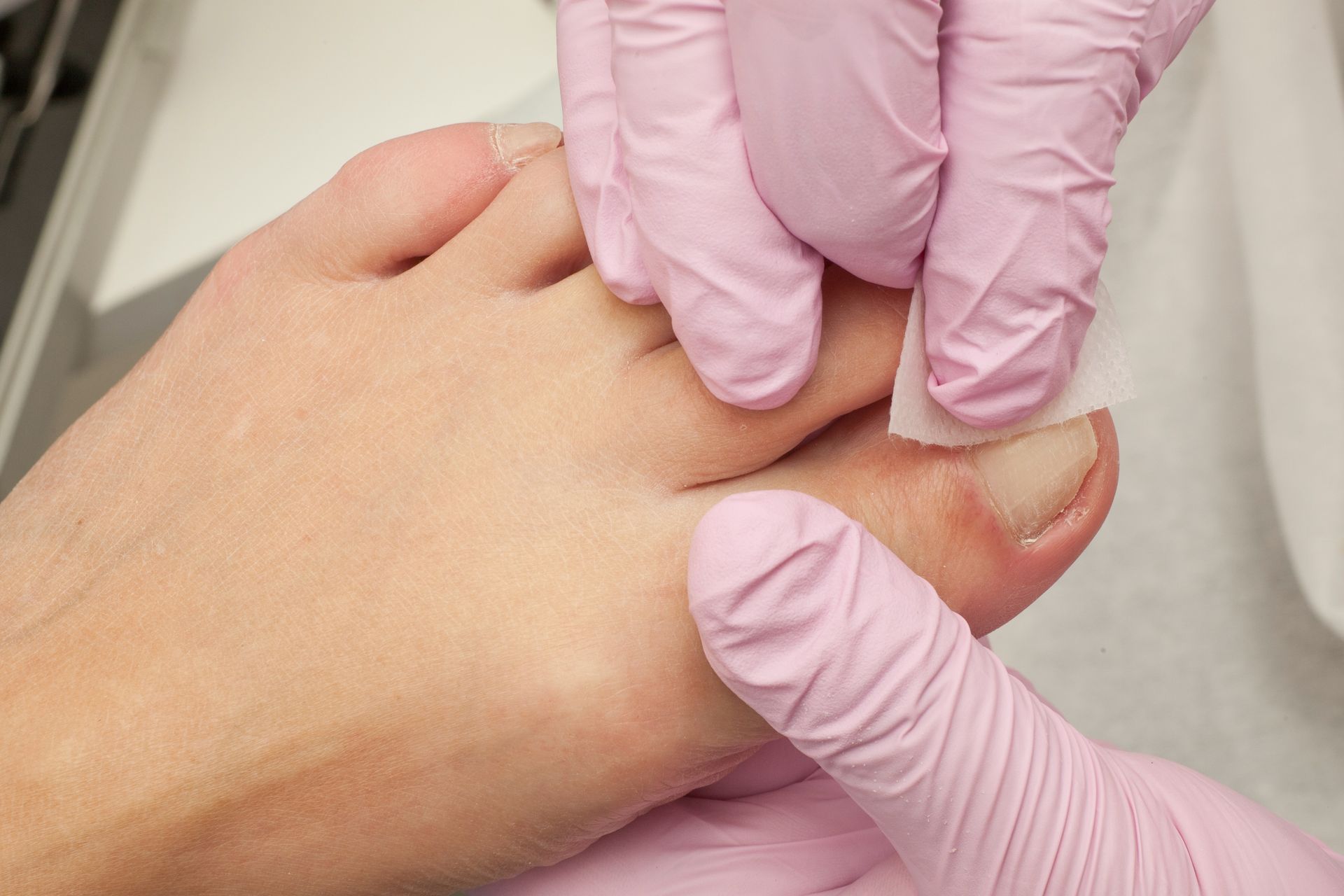 A Guide to Treating Ingrown Toenails: Finding Relief in Baton Rouge