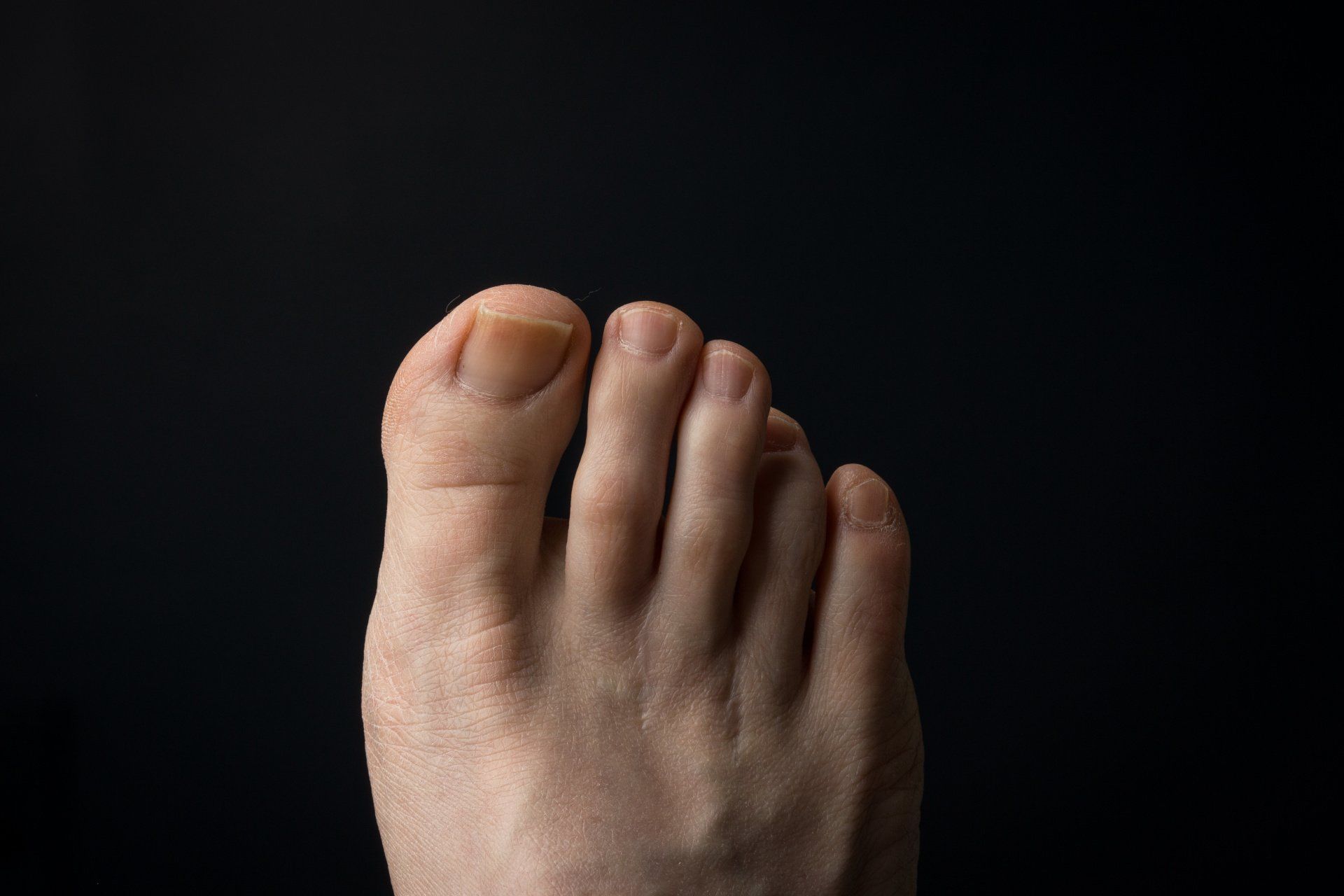 Diagnosing and Treating Morton's Neuroma in Baton Rouge