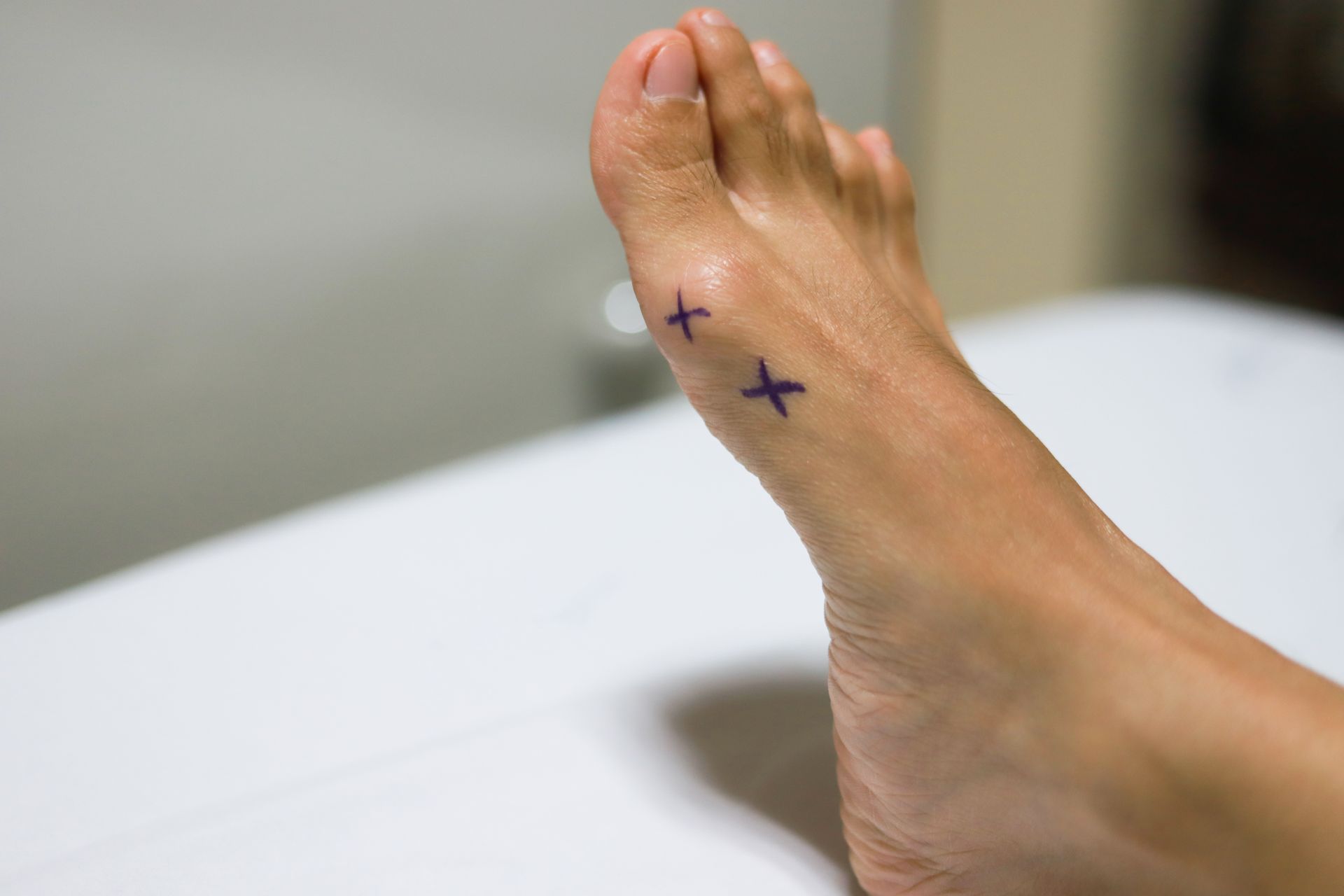 Benefits of Minimally Invasive Bunion Surgery