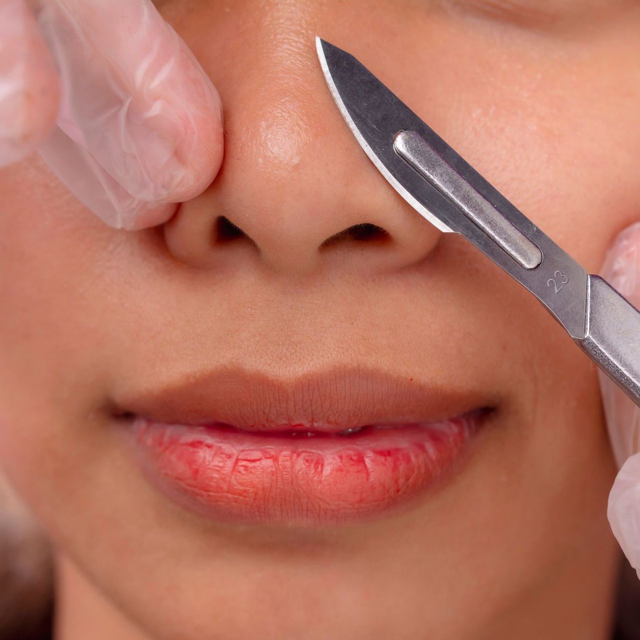 a woman getting dermaplaning on her nose