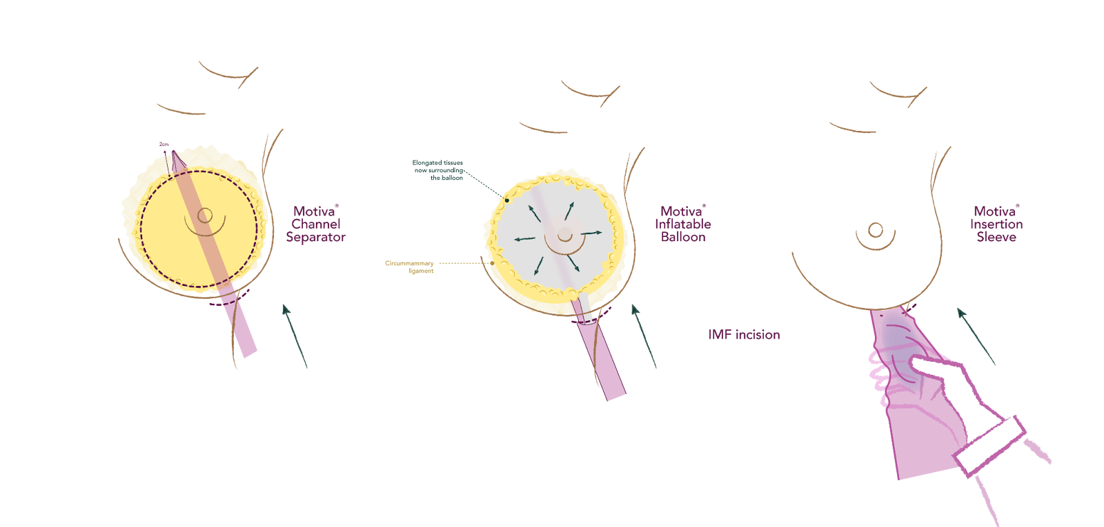 Breast Tissue Preservation