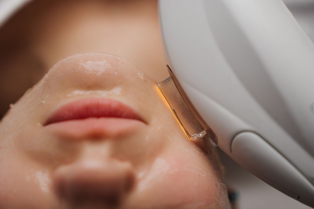 A close-up of a handheld laser device being applied to a person’s cheek during a cosmetic skin treatment.