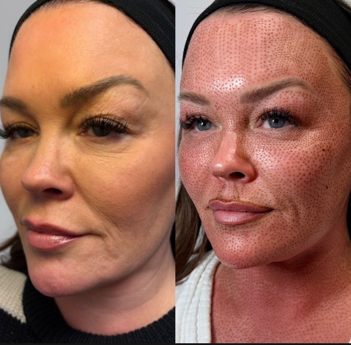 Side-by-side: woman's face before and after skin resurfacing treatment. Red dots cover face after treatment.