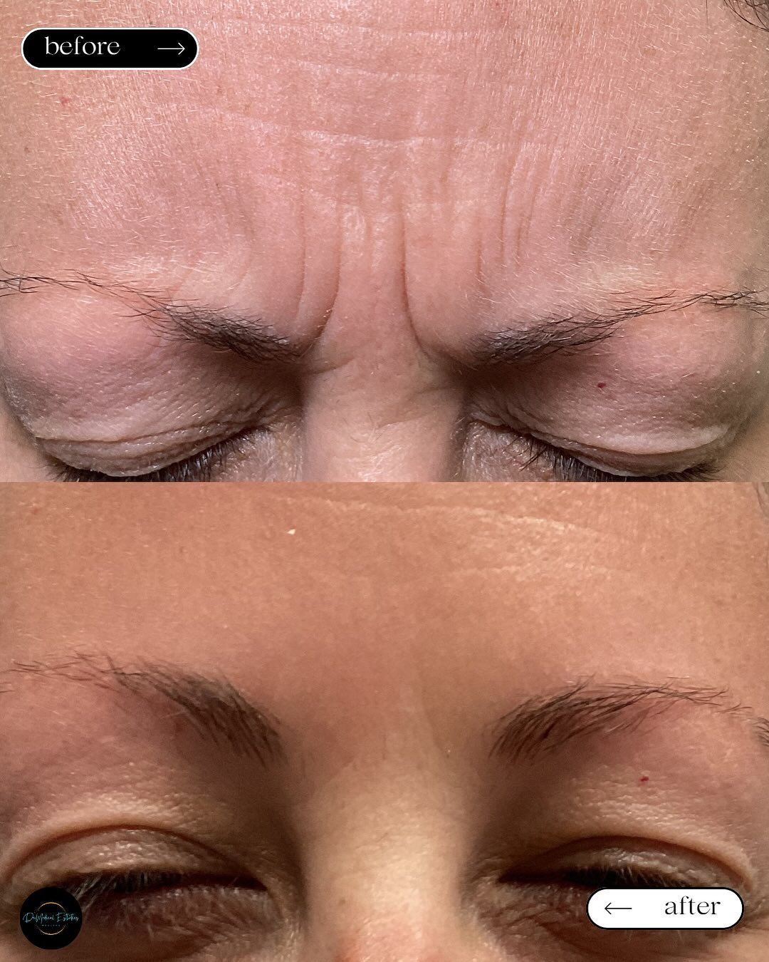 Wrinkles on forehead before and after a treatment, showing a smoother forehead after.