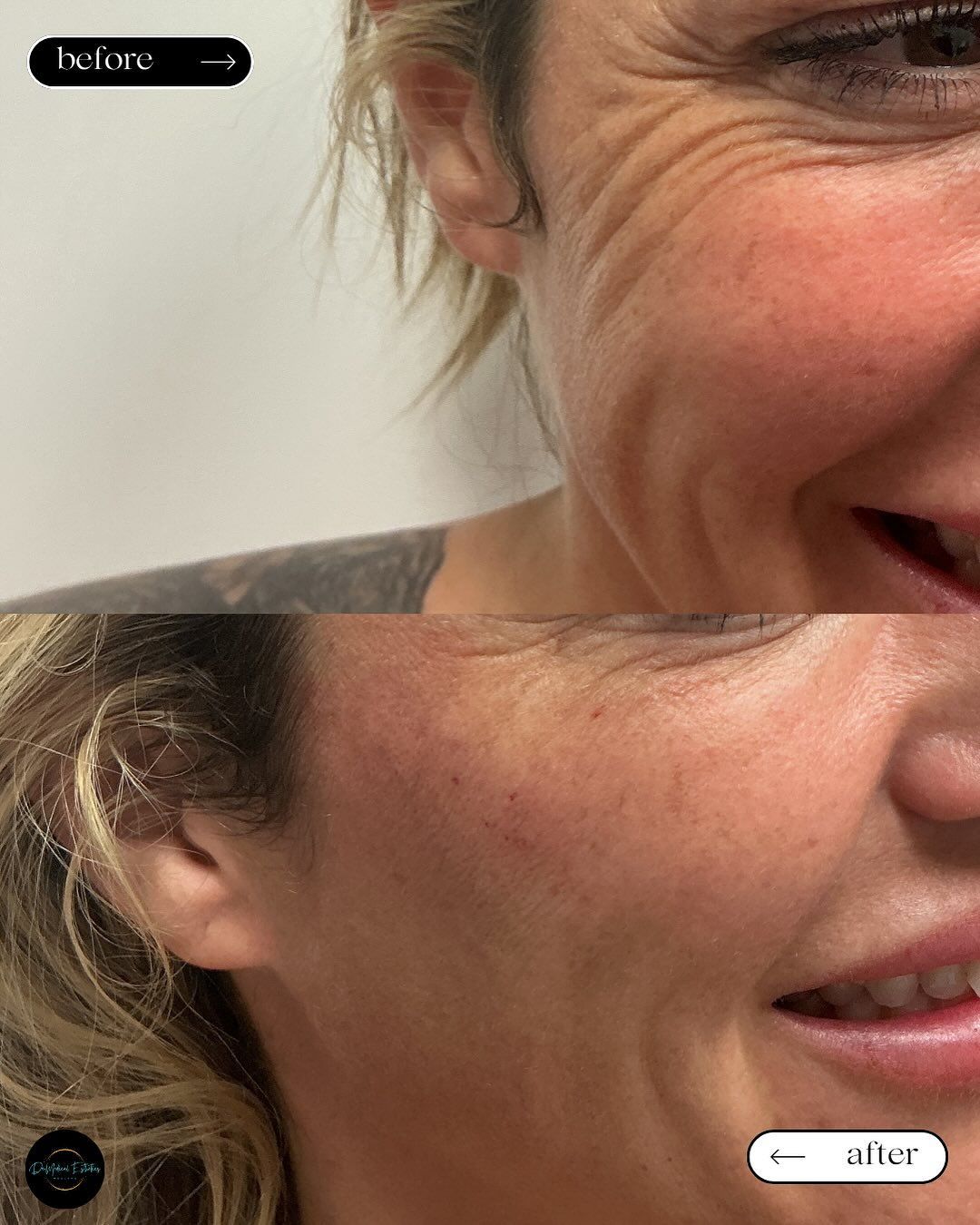 Before and after photos of a person's face. Top image shows wrinkles, bottom image shows smoother skin.