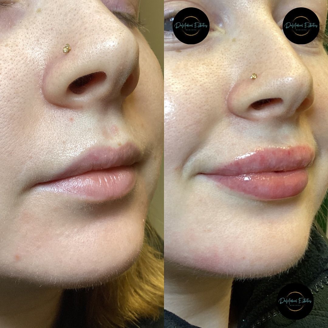Woman's face before and after a skin treatment; reddish dots cover the treated skin.