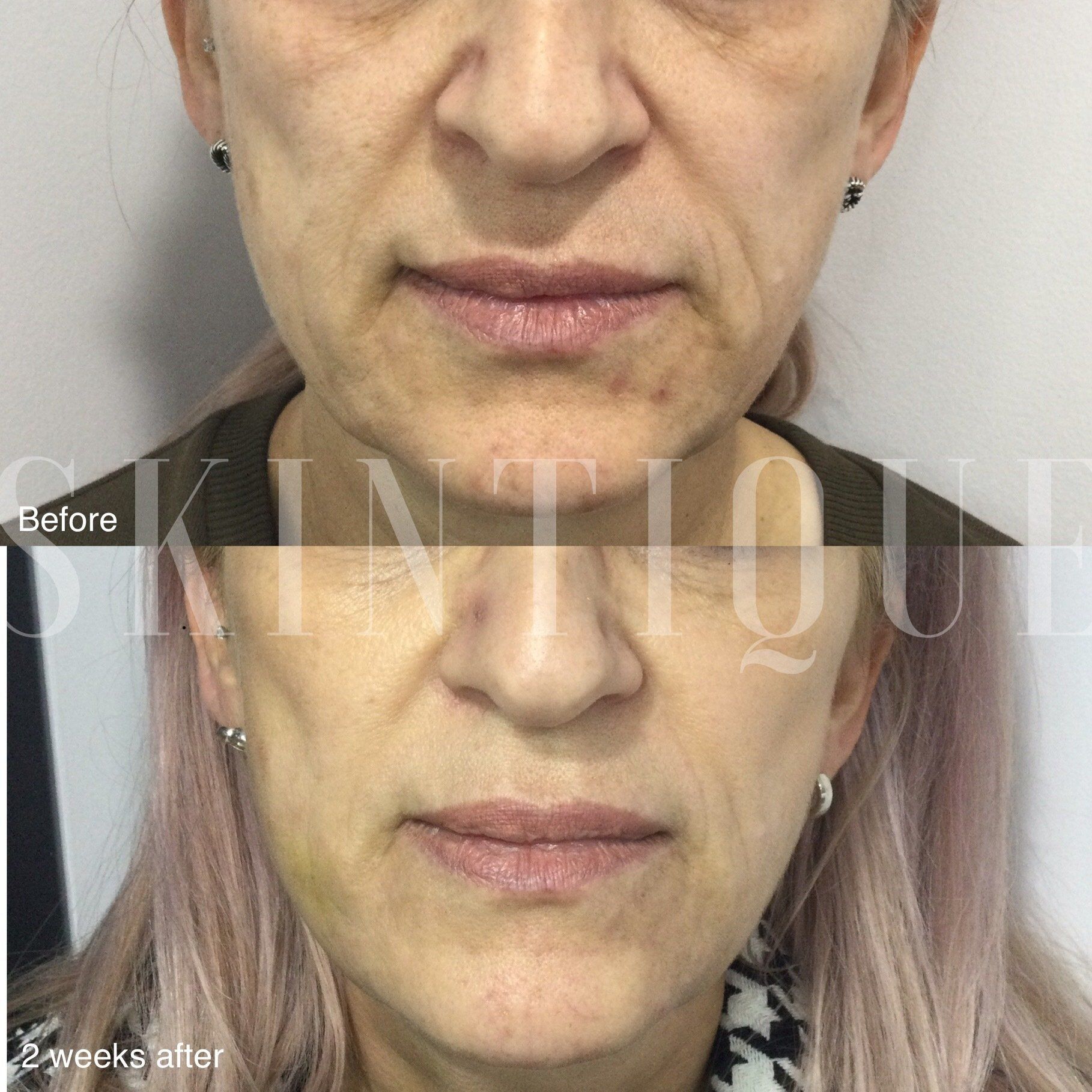 Pdo Mono Threads Treatment Skin Tightening Perth Pdo Mono Threads Treatment Skin Tightening Perth