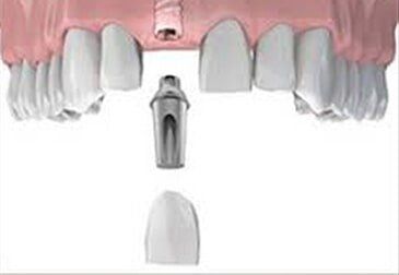 Tooth Implants — Riviera Beach, FL — Singer Island Dentistry
