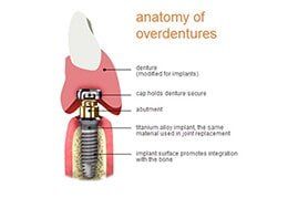Anatomy of Overdenture — Riviera Beach, FL — Singer Island Dentistry
