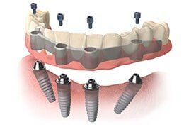 Hybrid Implant — Riviera Beach, FL — Singer Island Dentistry