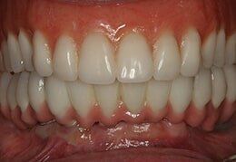 Complete Teeth — Riviera Beach, FL — Singer Island Dentistry