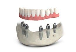 Implant — Riviera Beach, FL — Singer Island Dentistry
