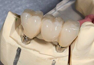 Dental Implant to Three Elements — Riviera Beach, FL — Singer Island Dentistry